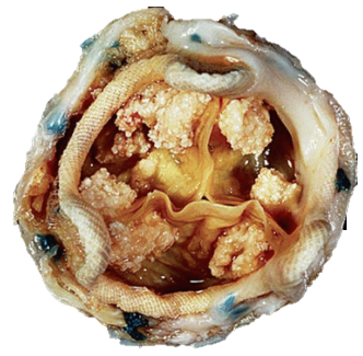 valve-01 Tissue Valve