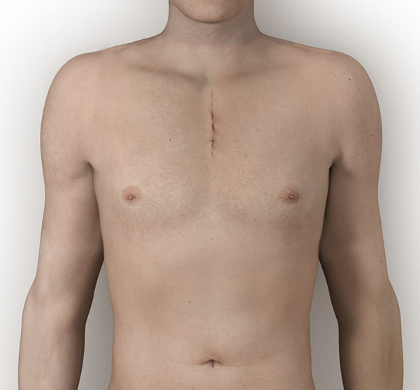 01-Semi-Hemo-Sternotomy-Closed-02