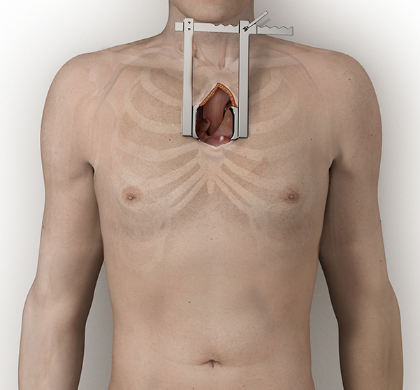 01-Semi-Hemo-Sternotomy-Closed-02