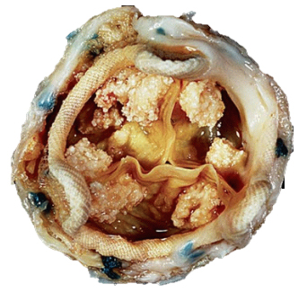 valve-02 Tissue Valve