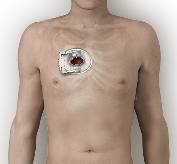 02-Right-Thoractomy-aortic-OPEN-02