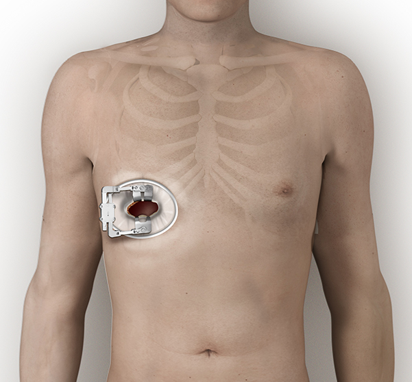 02-Right-Thoractomy-mitral-OPEN-02 Right-Thoractomy